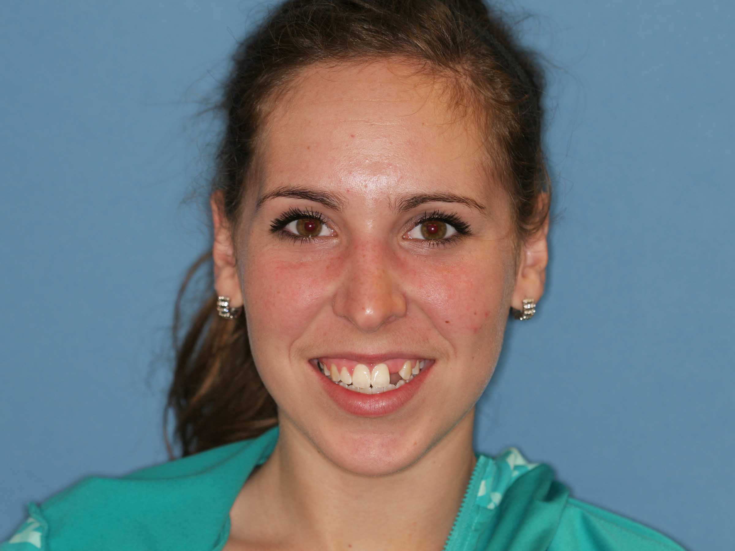 Diagnostics and a clear dental plan were established before her single-tooth implant