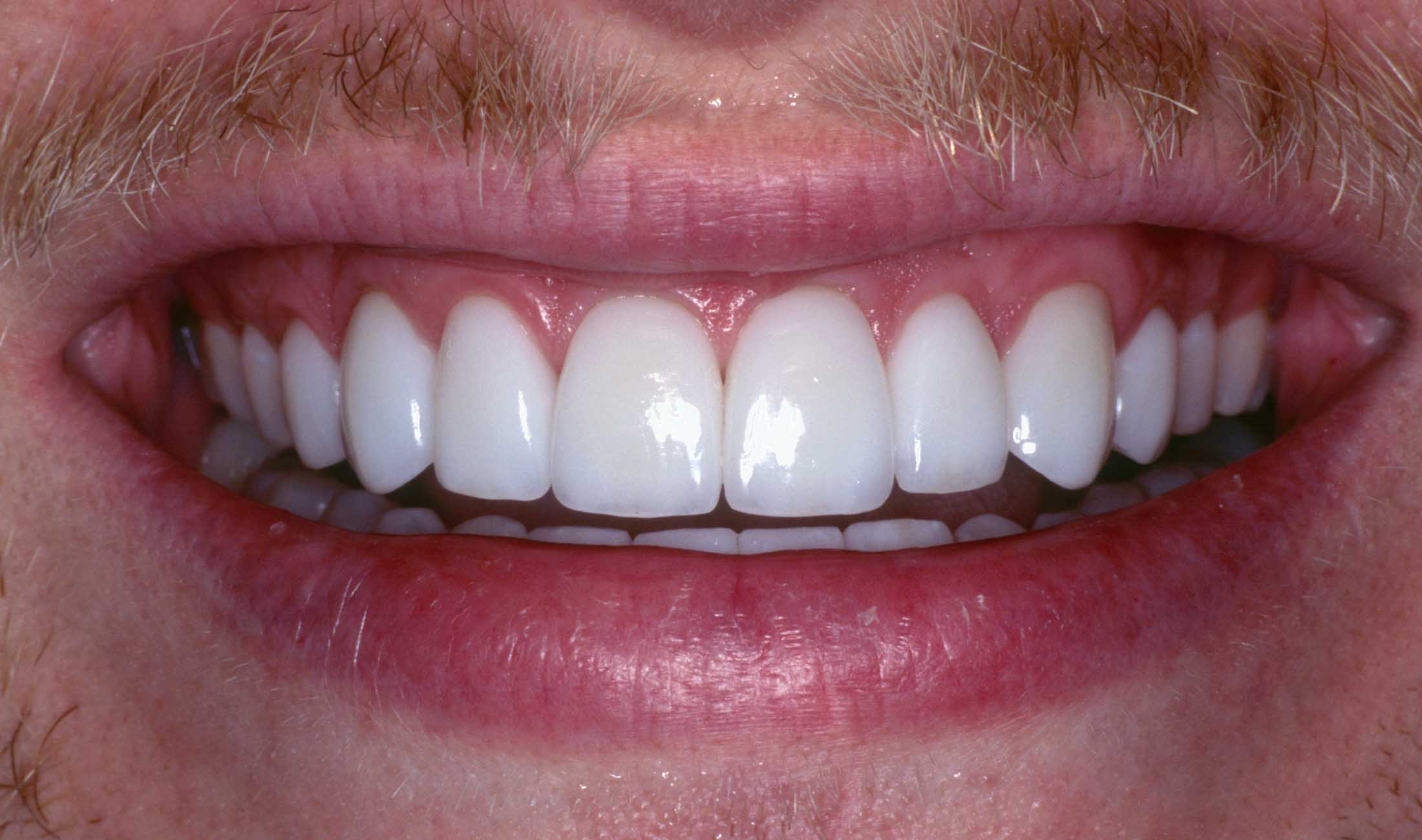Jason's Close-up Smile After Veneers