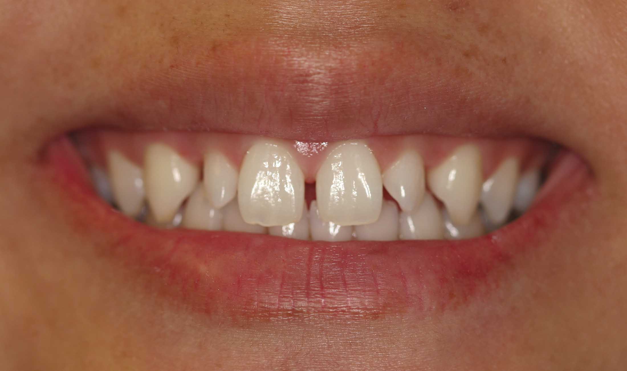 Johanna Close-up Before Smile Whitening and Veneers