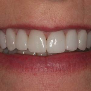 Julieanne' Smile After Whitening & Upper Teeth Veneers
