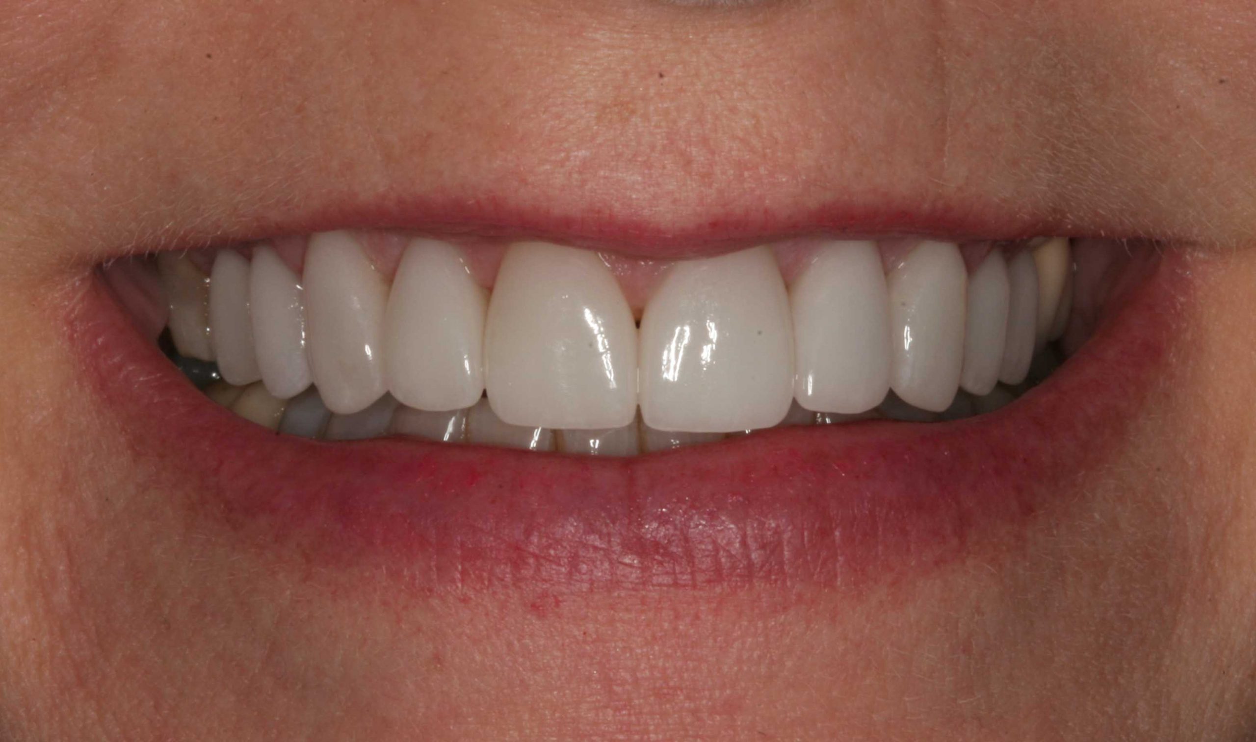 Julieanne' Smile After Whitening & Upper Teeth Veneers