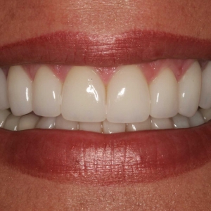 Loida's Smile After Whitening & Veneers