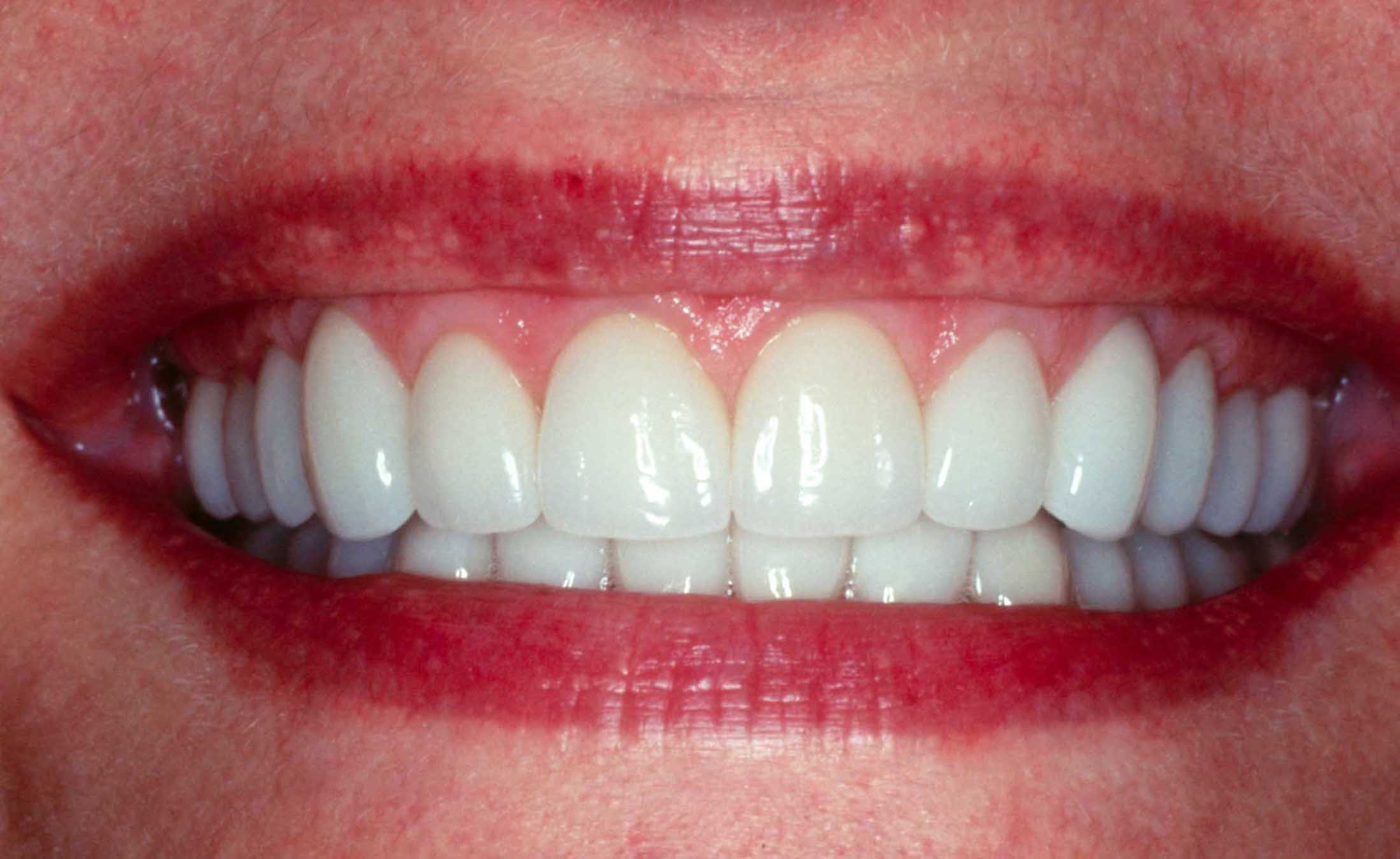 After Getting Porcelain Veneers and Porcelain Crowns Close-Up