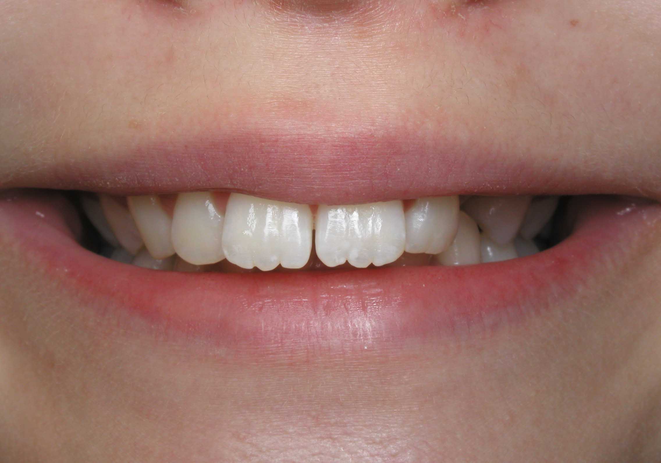Micayala's Close-up Smile Before Orthodontics