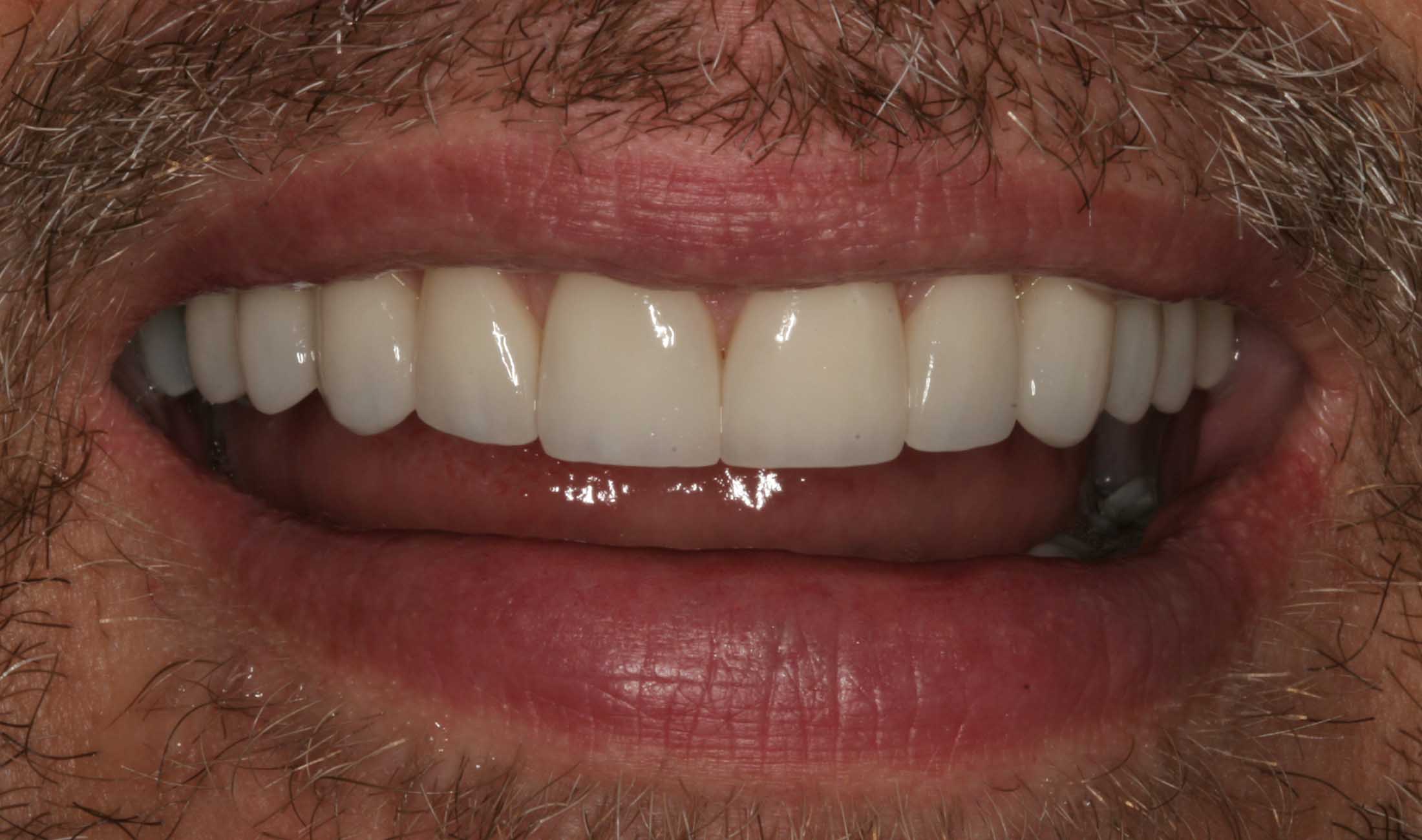 Patrick's Smile After Teeth Whitening and Veneers