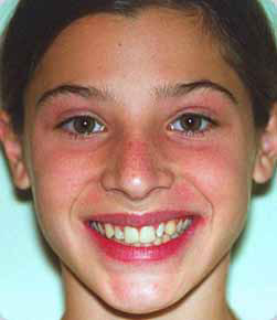 Travis  before orthodontics with Dr. Marc Montgomery in Woodbury, MN