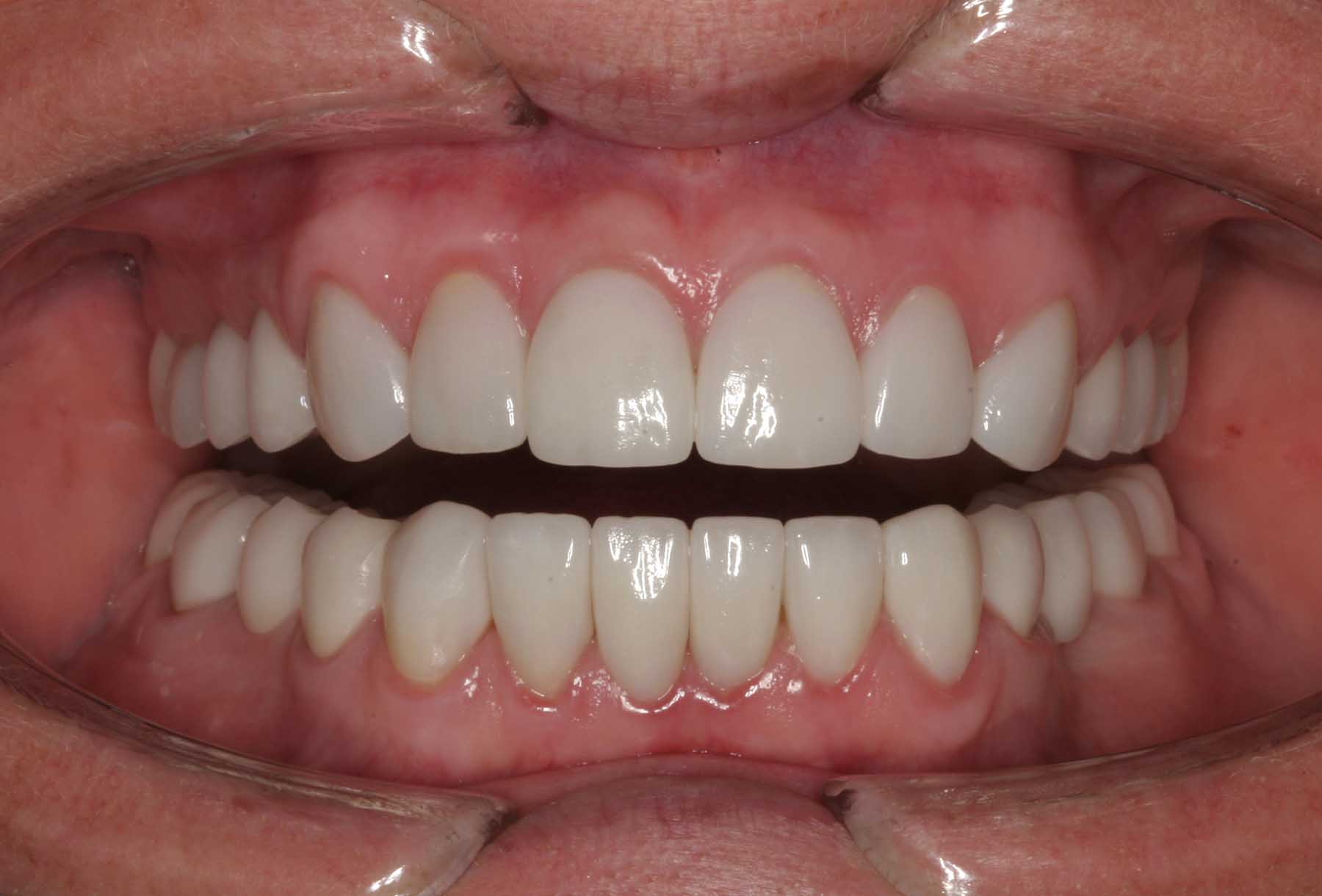 Mel after a non-surgical treatment at Montgomery Dental Care