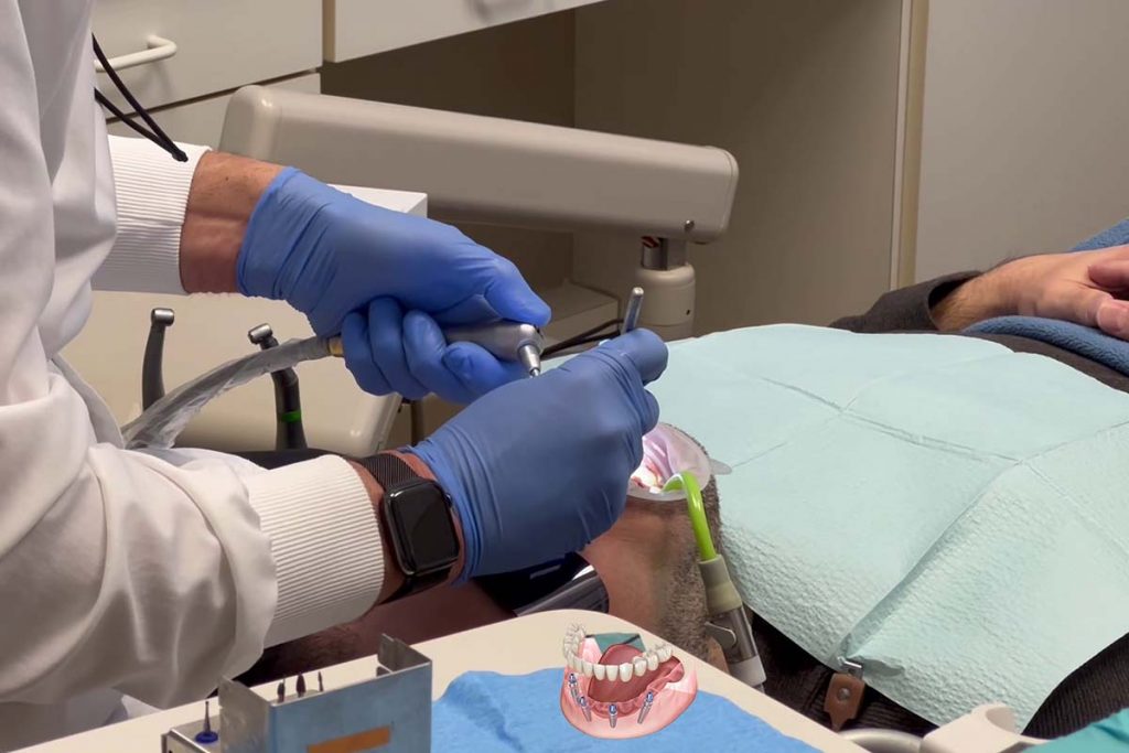 How to Care for Dental Implant Restorations